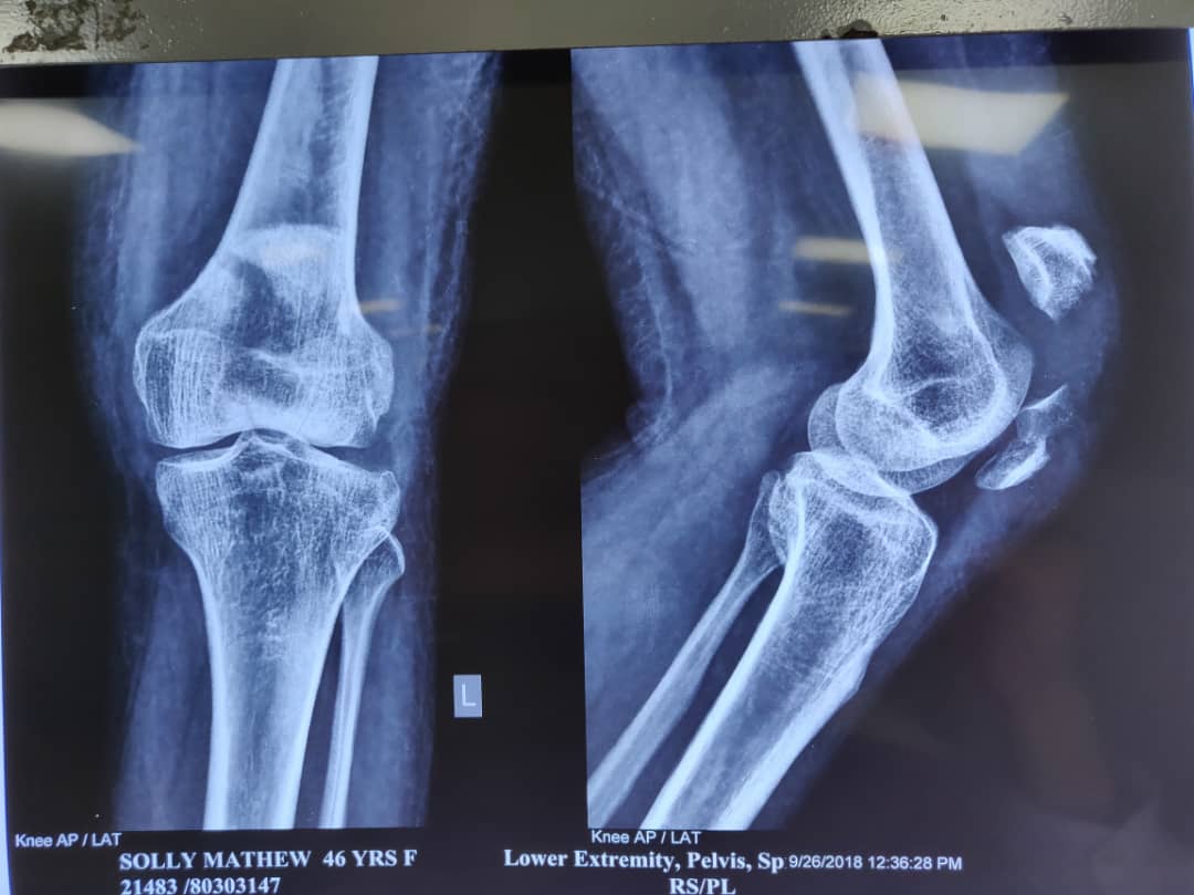 Should We Preserve The Knee Cap Or Dispose It?